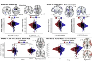 Low-intensity transcranial focused ultrasound amygdala neuromodulation
