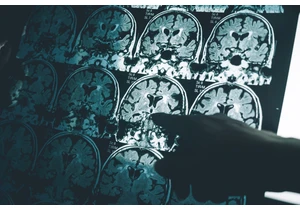 How the Alzheimer's Research Scandal Set Back Treatment 16 Years