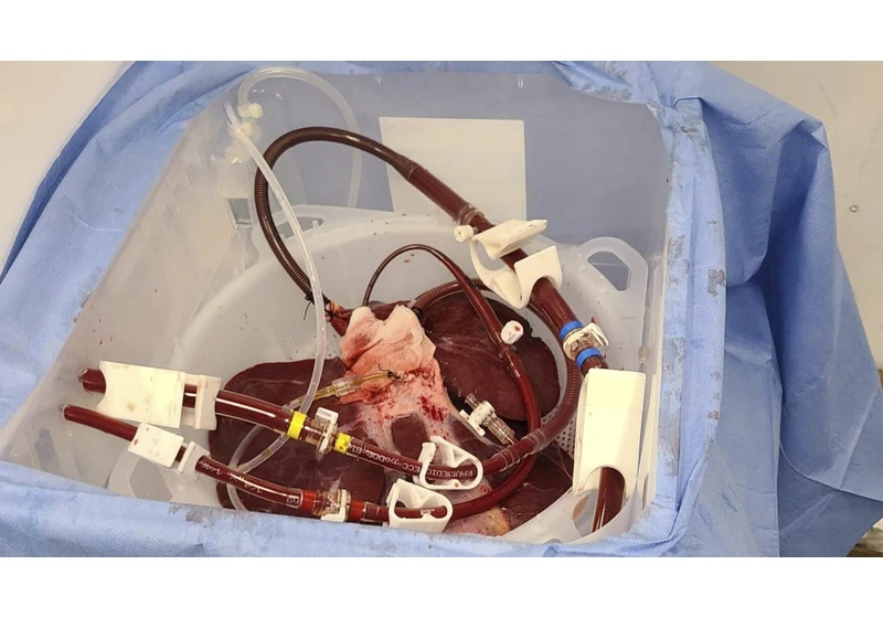 Scientists have figured out how to make a pig liver filter human blood