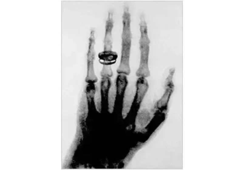 How did X-Rays gain mass adoption?
