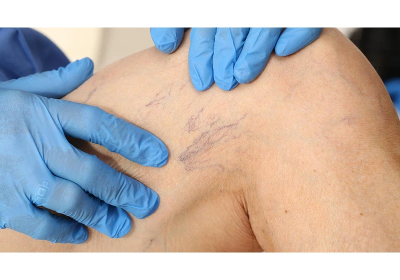 Chronic Venous Insufficiency: A Vein Specialist on Causes and Symptoms for Trump's Diagnosis