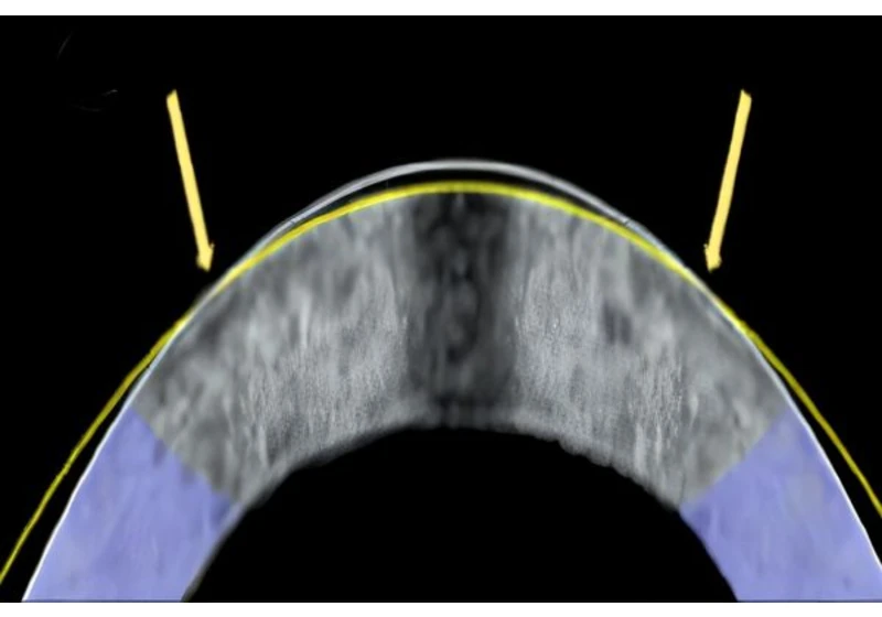 Electromechanical Reshaping Offers Safer Eye Surgery