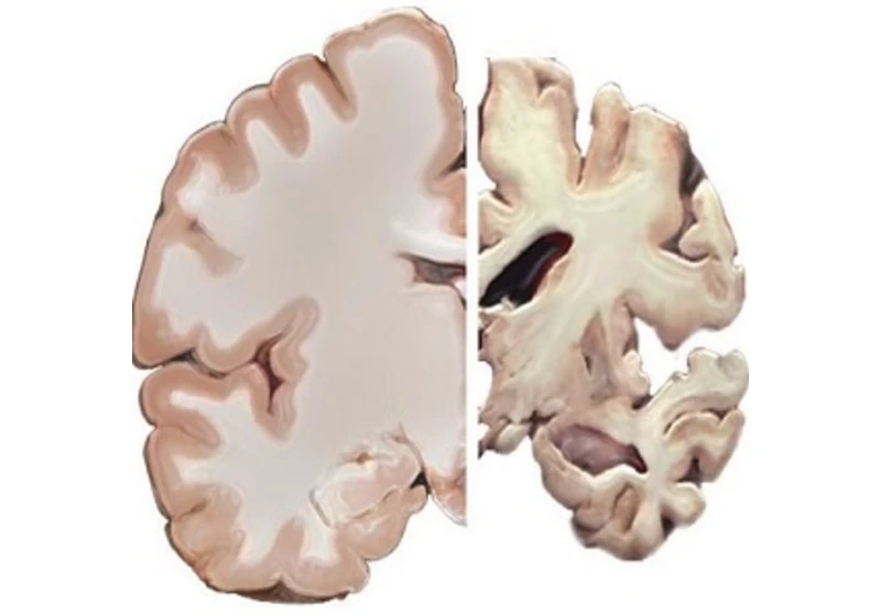 Alzheimerova choroba souvisí i s poruchou činnosti imunitních buněk
