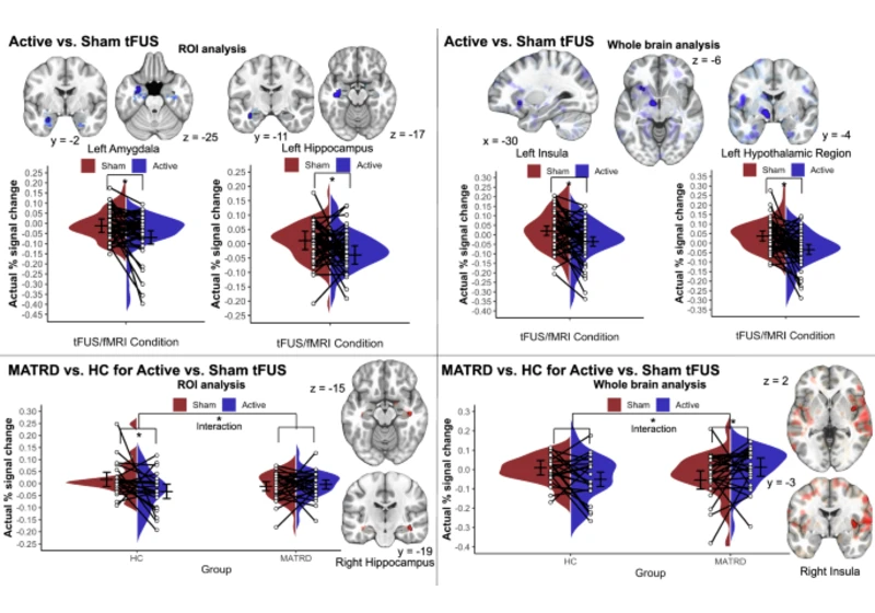 Low-intensity transcranial focused ultrasound amygdala neuromodulation
