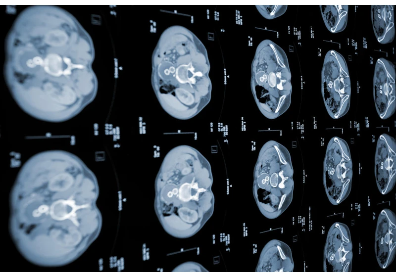 MIT experts develop AI models that can detect pancreatic cancer early
