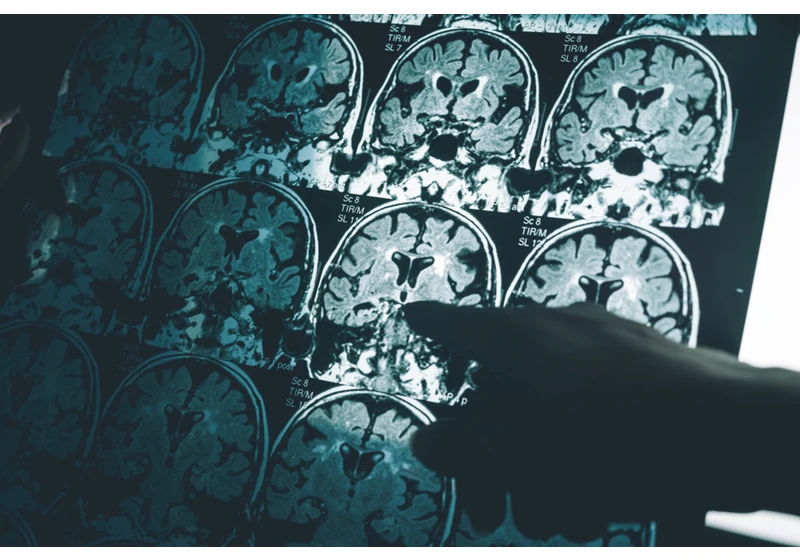How the Alzheimer's Research Scandal Set Back Treatment 16 Years