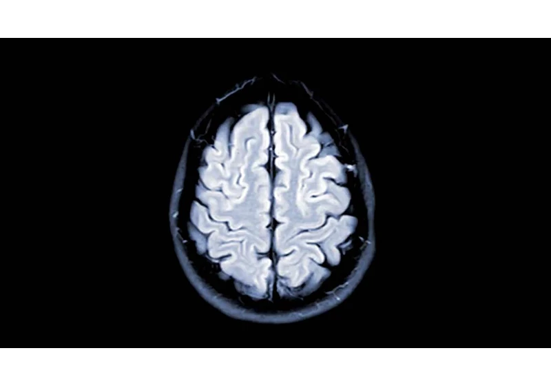 Poor Sleep in Midlife Is Linked to Faster Brain Atrophy